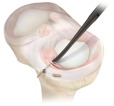 Knee Specialist Belfast Meniscal Repair